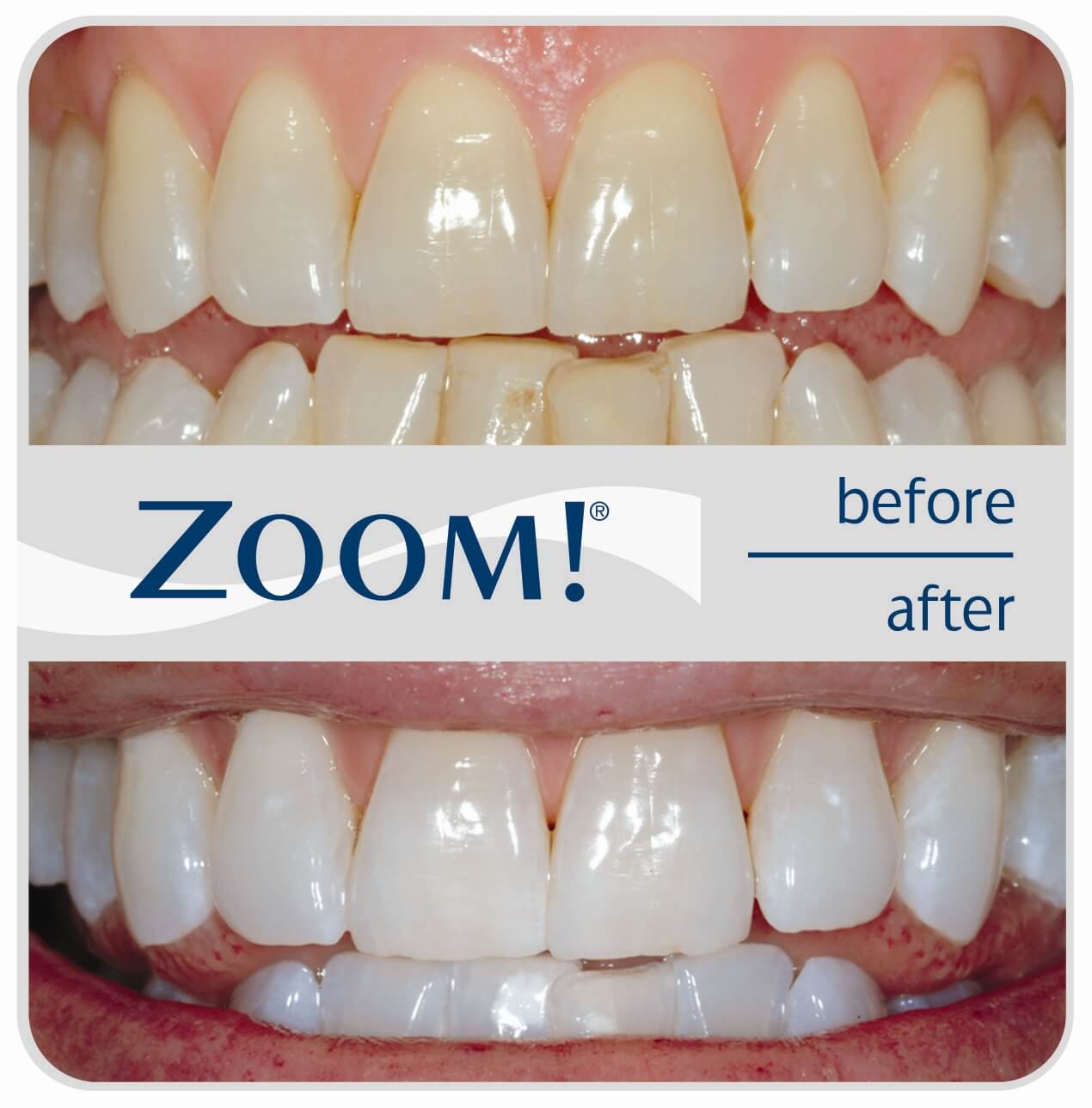 Zoom Teeth Whitening Costs Reviews The Dental Guide