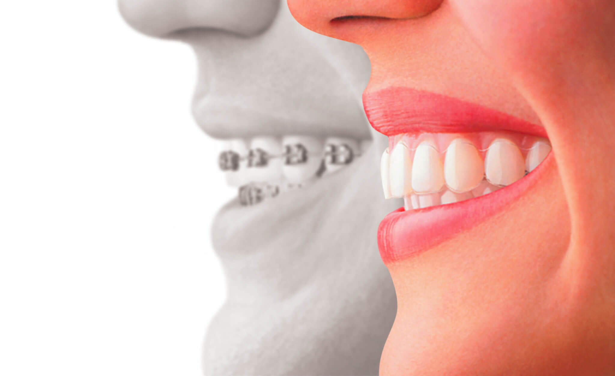 A Guide to Invisible Braces - The Dental Guide USA