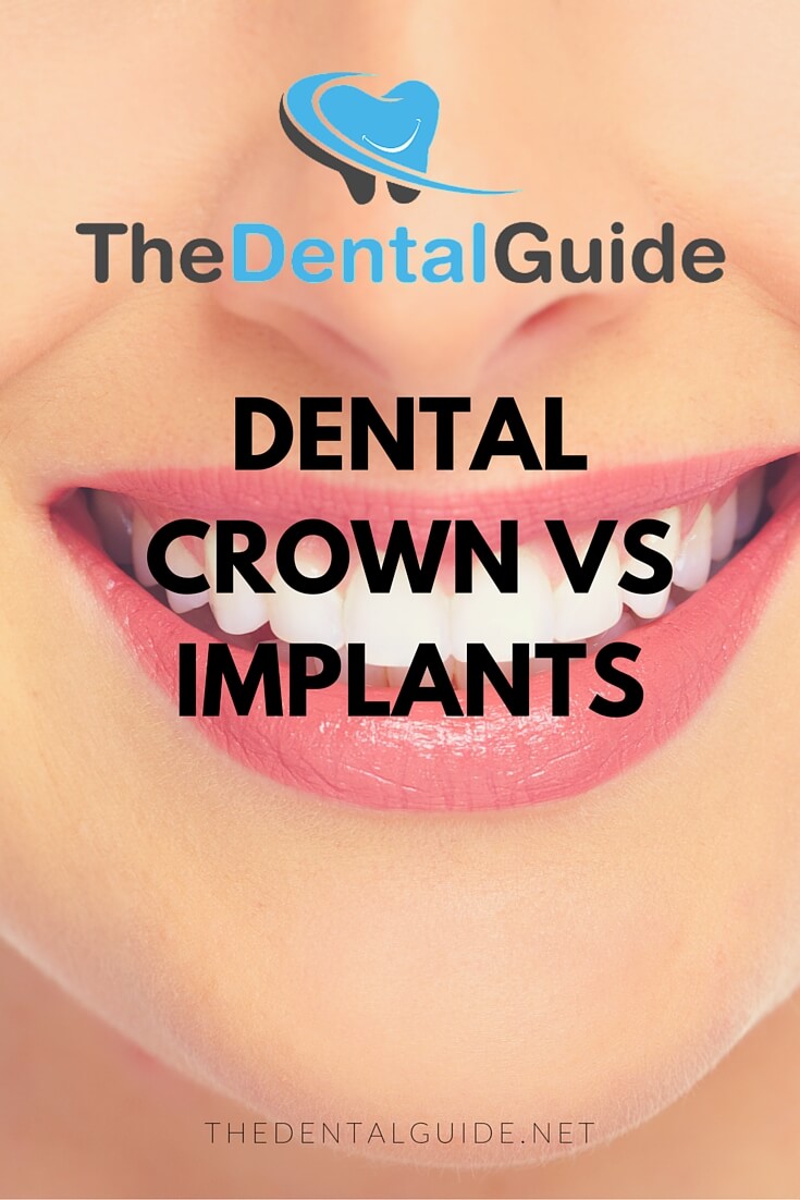 dental-crown-vs-implants-the-dental-guide