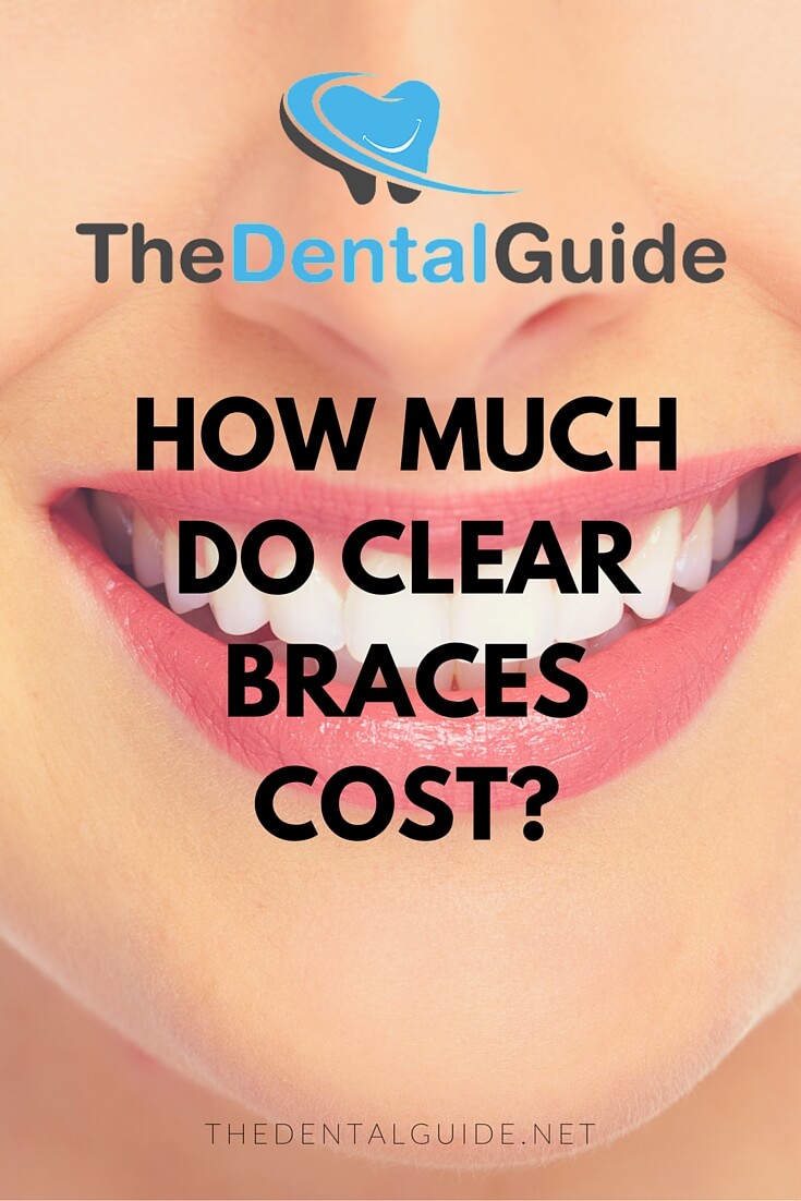 How Much Do Clear Braces Cost? The Dental Guide