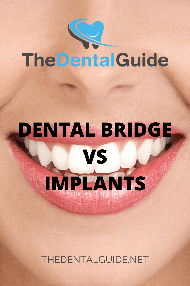 Dental Bridge vs Implants - The Dental Guide