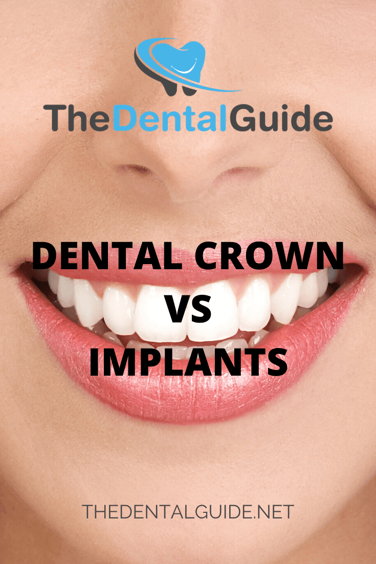crown dental implants vs implant guide