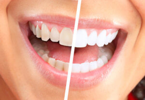 Teeth Whitening Cost And Information - The Dental Guide