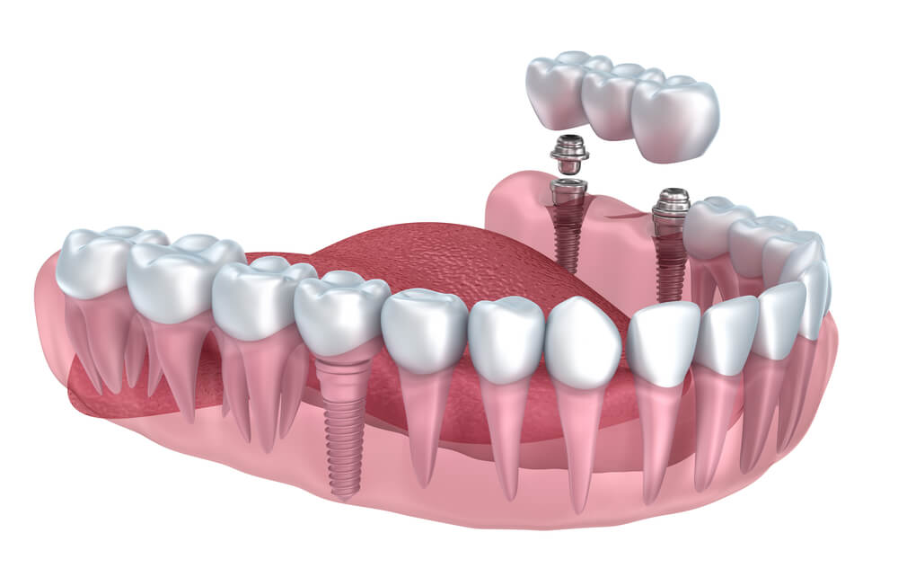 Dental Implant Costs In The UK Find Cheap Tooth Implants Dental Guide